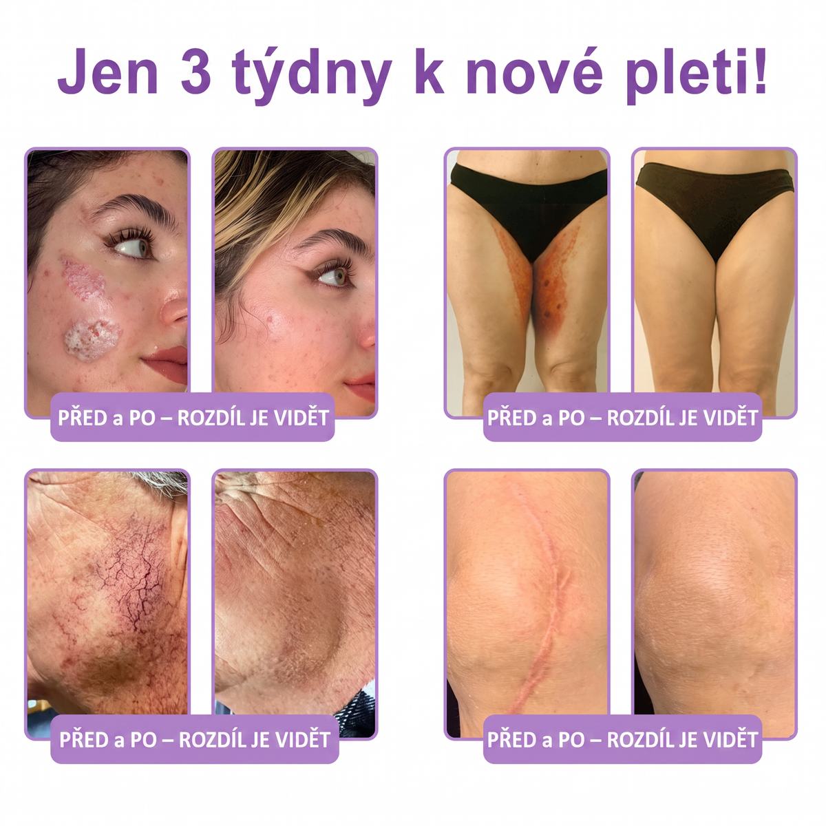 Vitalisys®🍃PDRN Multi-Peptide Masážní tělový krém s válečkem — proti stárnutí, hydratuje, zpevňuje a liftinguje pokožku, podporuje regeneraci, sjednocuje tón pleti a pečuje o nedokonalosti a tmavé skvrny.